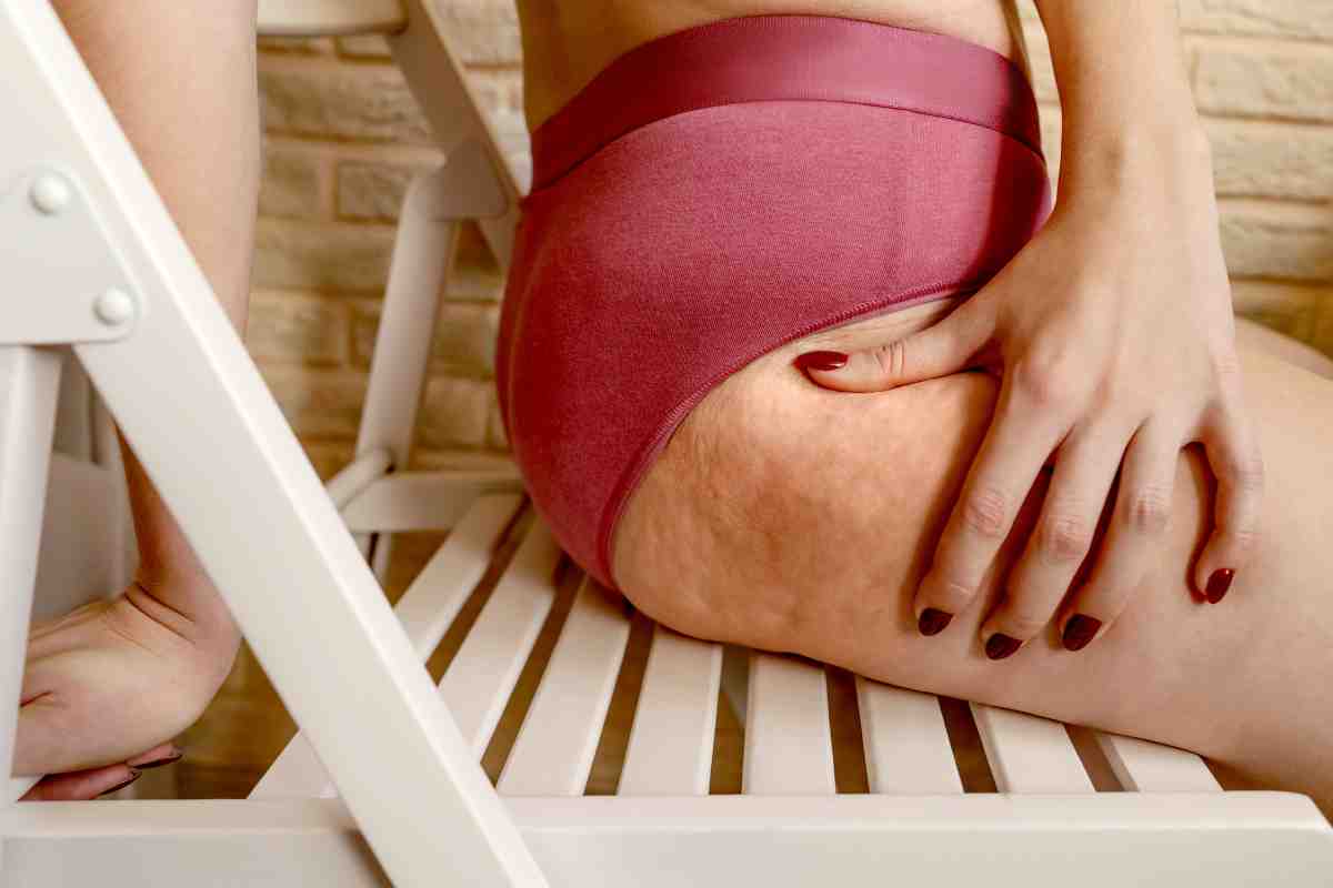 Come debellare la cellulite